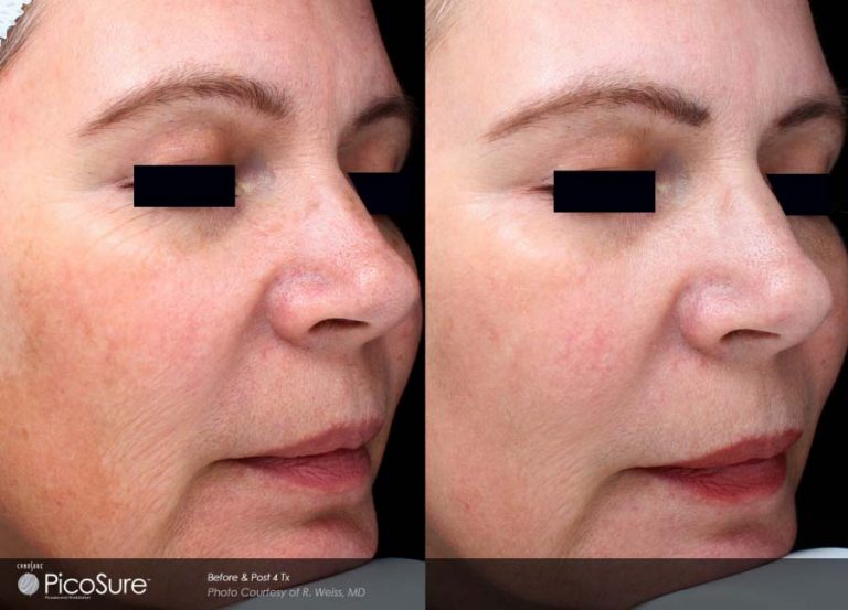 Laser Skin Rejuvenation Facial Rejuvenation Prolaser Clinic
